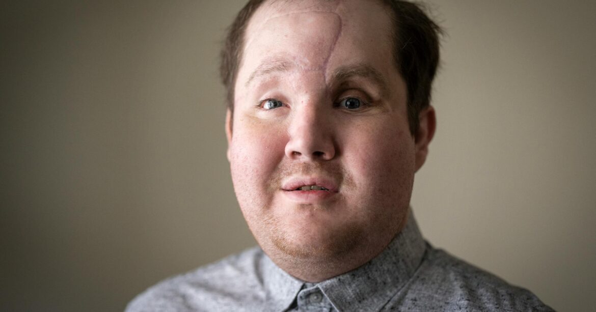 A Patient Who Received A Face Transplant At Rochester's Mayo