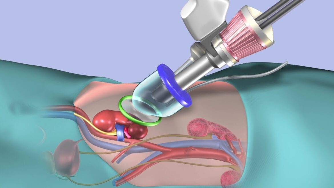 Cleveland clinic's first in the world to perform robotic single port