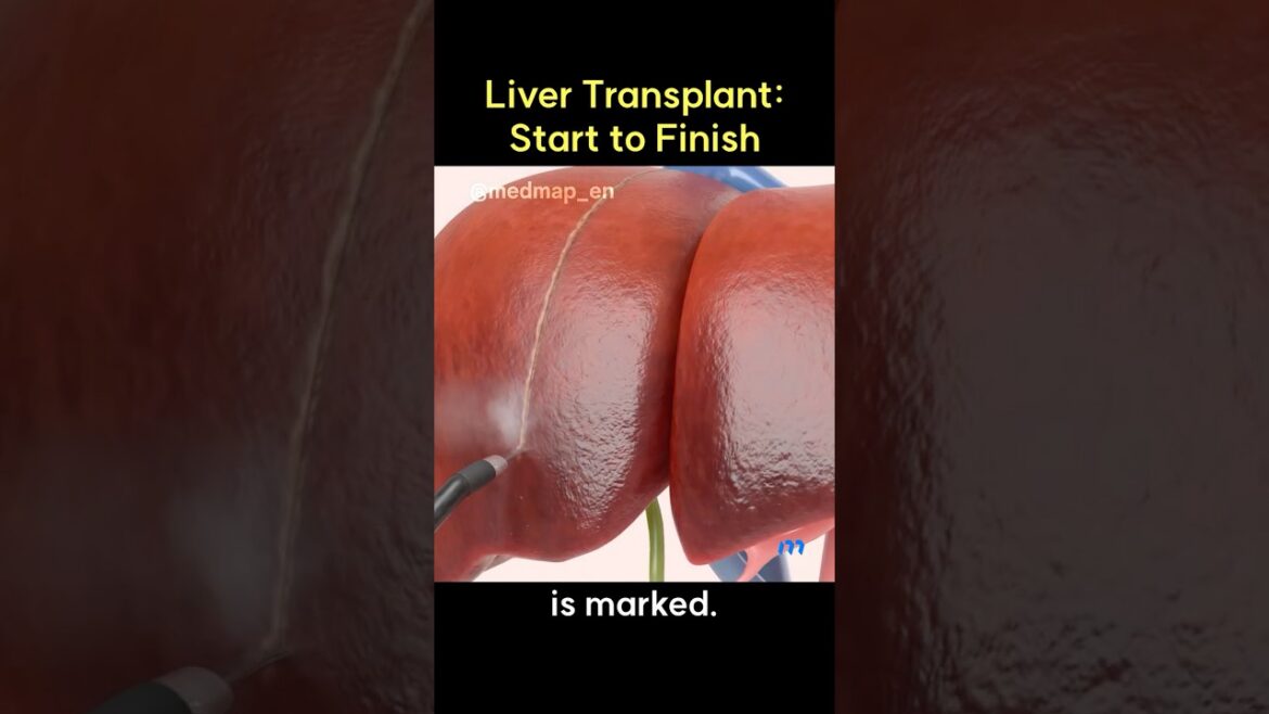 Liver transplant: start to finish